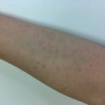 子どもだけじゃない!手足口病に大人がかかった時の症状とは!?